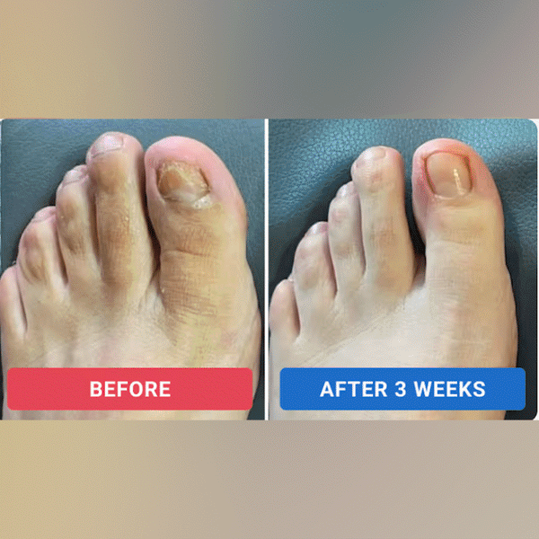 FungalFix Nail Renewal Patches Petaliya